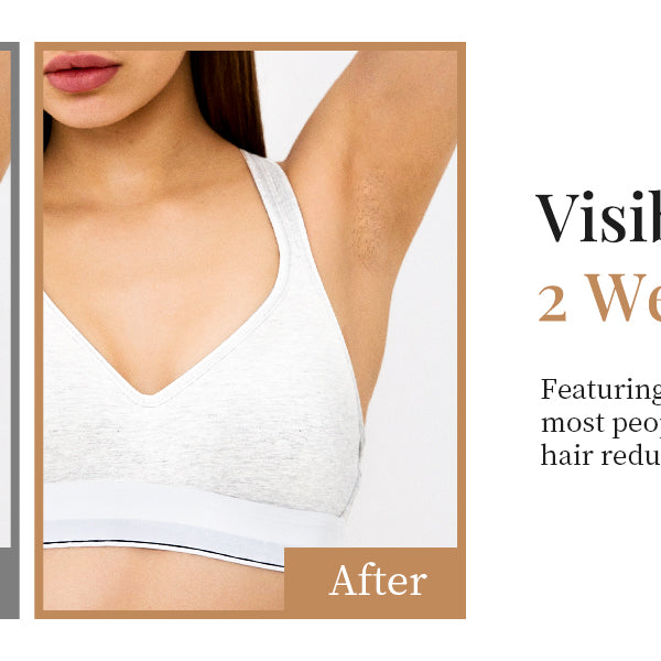 IPL Hair Removal Device